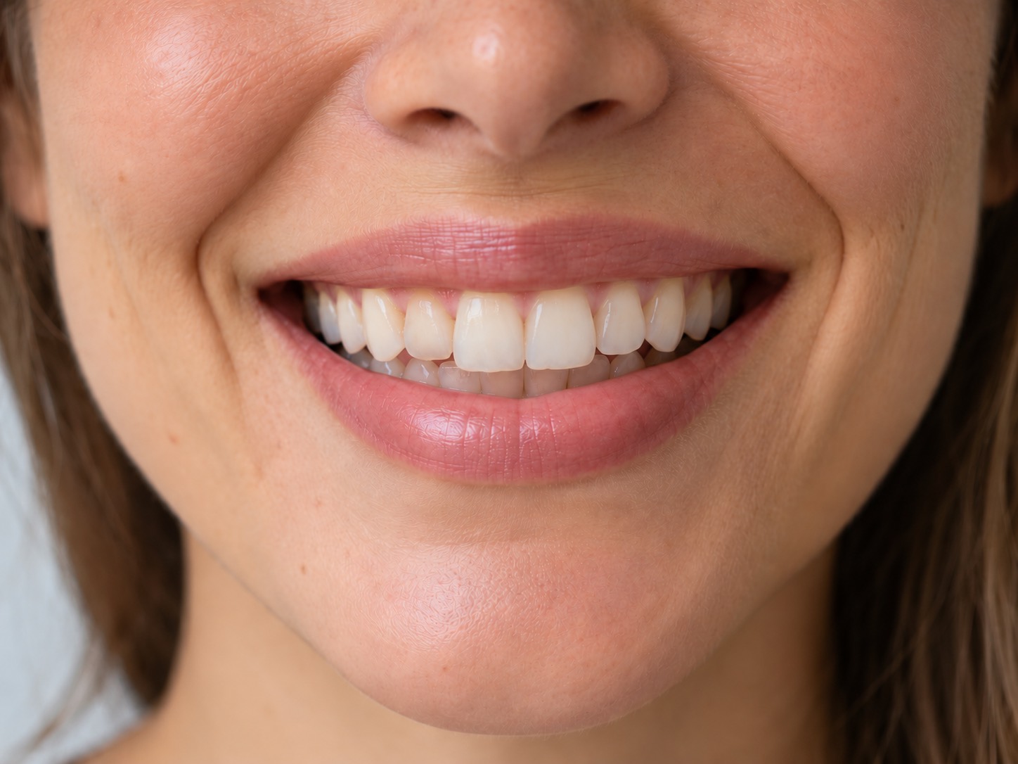 Illustrative smile after treatment