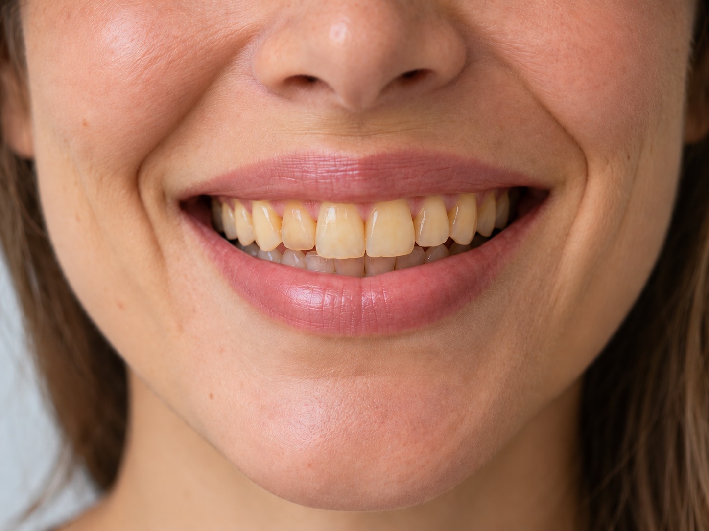 Illustrative smile before treatment
